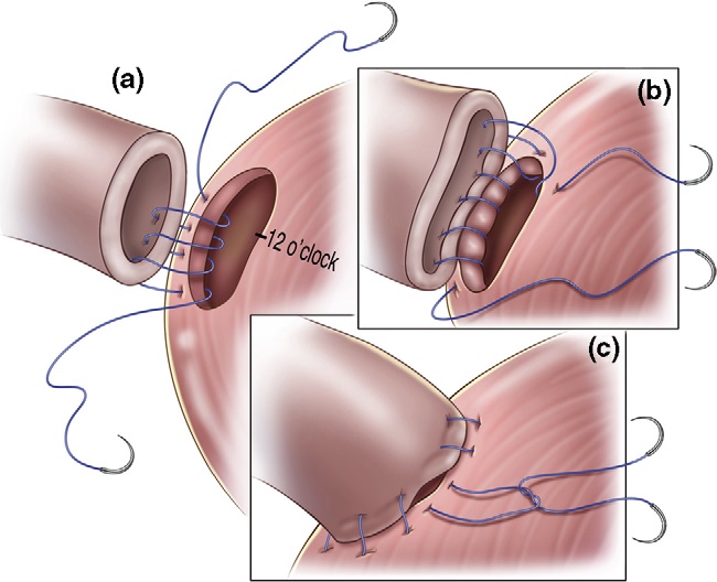 Anastomose vesicouretral — reconexão da bexiga à uretra após remoção da próstata