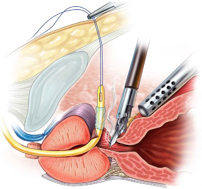Dissecção do colo vesical — separação da bexiga da próstata