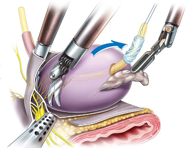 Dissecção dos feixes neurovasculares — nervos erigentes ao redor da próstata